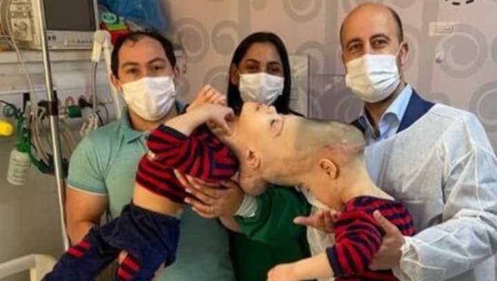 How Kashmir-origin doctor separated Brazilian twins fused at the brain