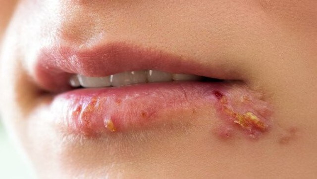 Herpes Infections Types Causes Risks And Treatment