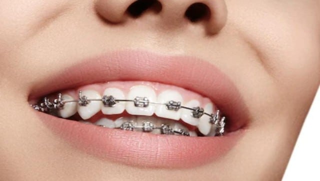 Dental aligners: Wide gap in knowledge and training needs to be corrected for acceptability