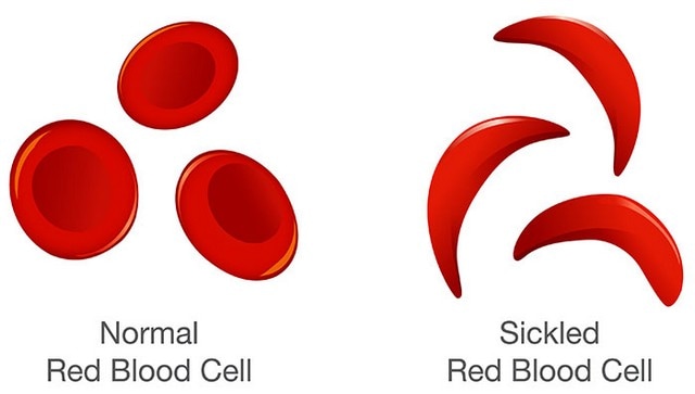 What is sickle cell anaemia, which India plans to eliminate by 2047? What is sickle cell anaemia, which India plans to eliminate by 2047?