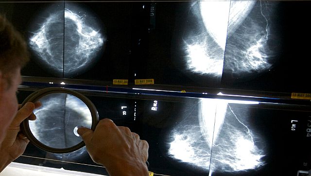 How breast tissue density can help in detecting breast cancer risk ...