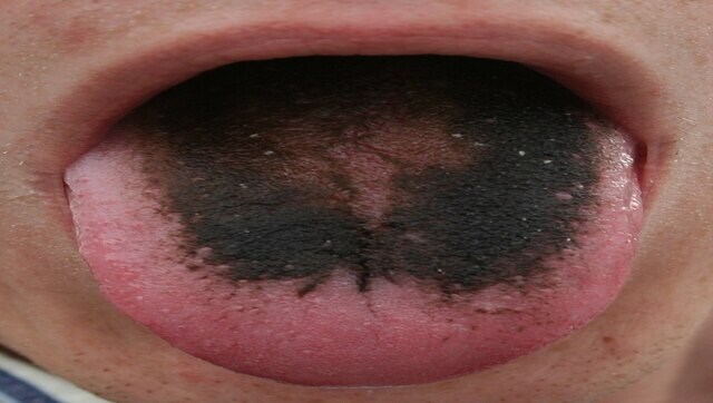 زبان زن سیاه و پرمو می شود، پوست صورت به دلیل واکنش آنتی بیوتیکی تغییر رنگ می دهد