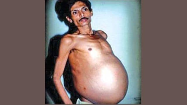 Read more about the article Nagpur man carrying twin inside not first
