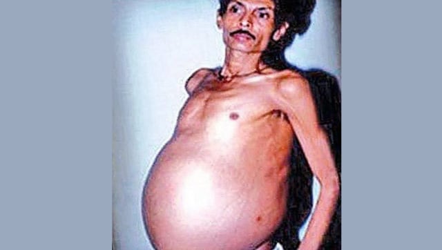 Read more about the article Maharashtra man carried twin inside body for 36 years thinking he was fat all along