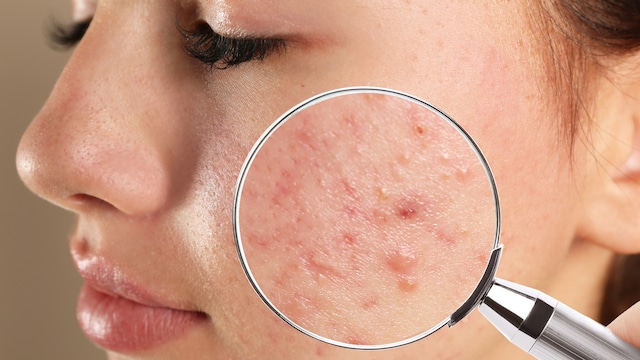 Identifying the culprits of Acne and Navigating Effective Treatments