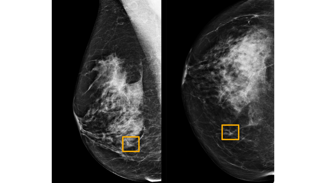 Artificial intelligence from Google is performing at par with doctors in identifying breast cancer on mammograms Artificial intelligence from Google is performing at par with doctors in identifying breast cancer on mammograms