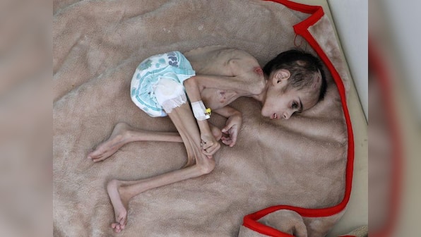 Yemeni boy, ravaged by hunger, weighs 7 kg