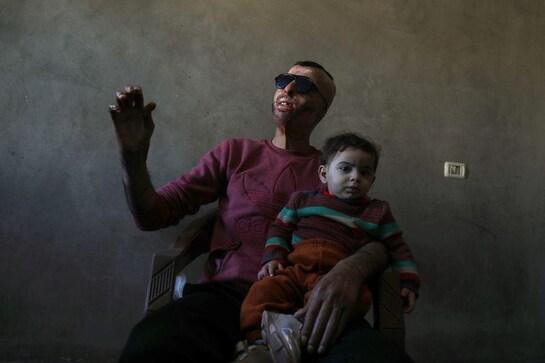 Gaza burn victims get 3D-printer face masks made close to home Gaza burn victims get 3D-printer face masks made close to home